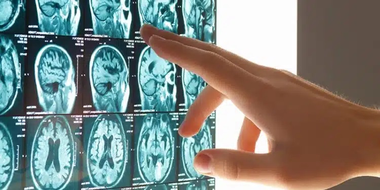 Tunisie: Un AVC est enregistré toutes les 30 minutes et un décès toutes les deux heures