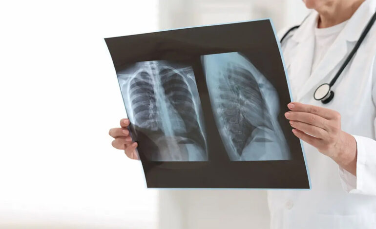 Cancer du poumon : 3000 nouveaux cas par an en Tunisie