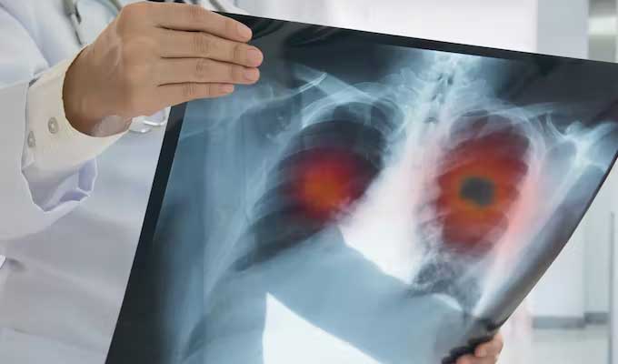 Prévention du cancer du poumon : Lancement du programme de dépistage précoce au 2ème trimestre 2025