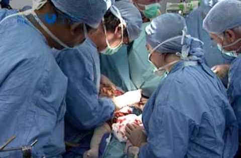 Prouesse médicale : Des siamois liés par la tête séparés avec succès  