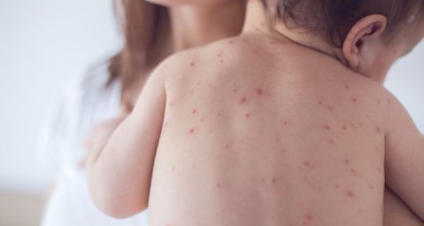 Rougeole: 850 cas et décès de 6 bébés à Kasserine depuis le début de l’année