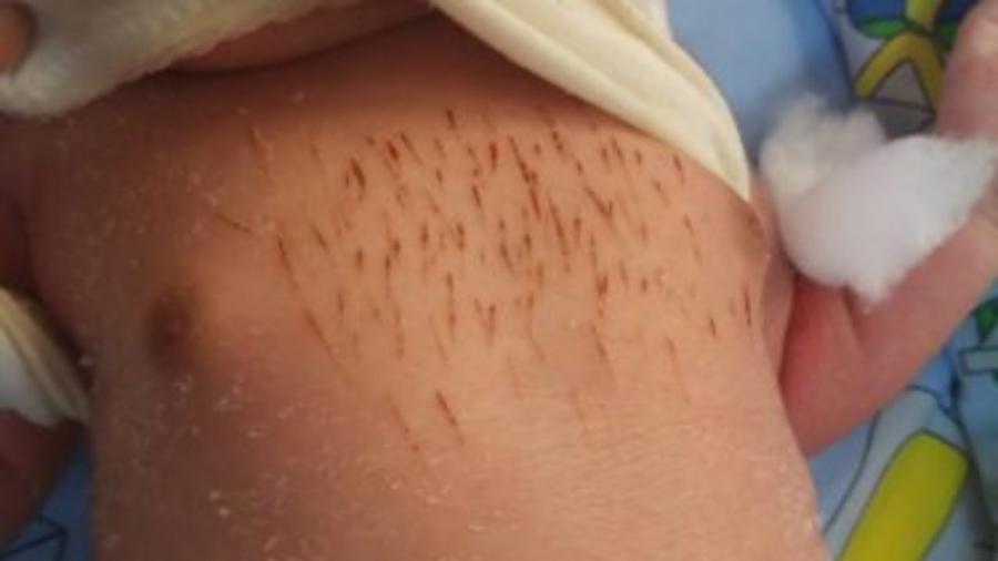 Kairouan : Deux jumelles victimes de scarification décèdent