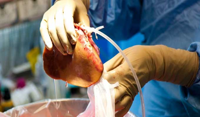 Transplantation d’organes : 2022 a été positive mais les besoins dépassent de loin les dons