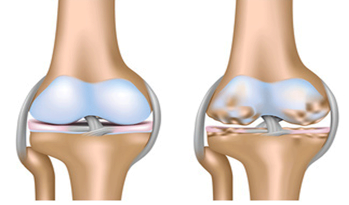 Santé : L’usure du cartilage du genou touche 30 à 40 % des personnes âgées de plus de 45 ans 