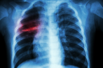 Tuberculose